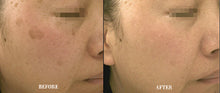Load image into Gallery viewer, GlowOn Laser Skin Rejuvenation Device - Home Facial Solution
